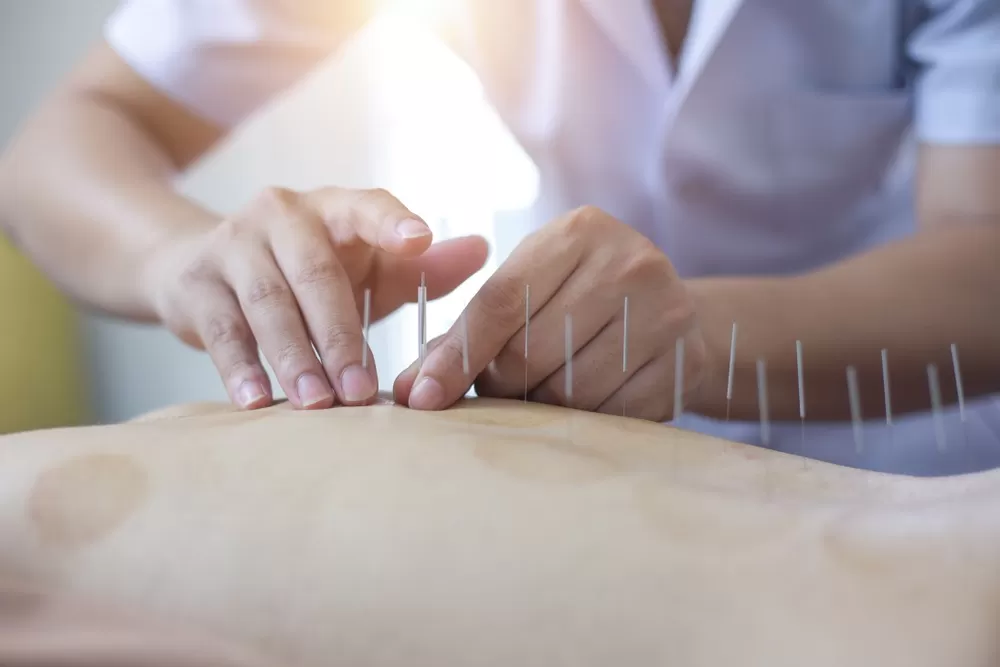 Acupuncture-in-Oakville