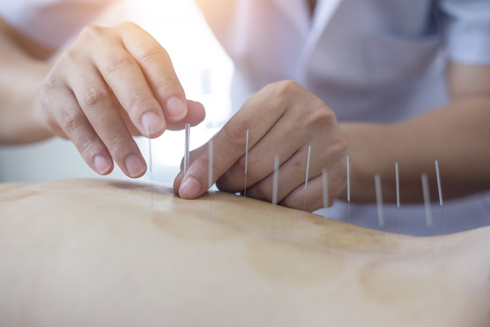 Acupuncture-treatment-in-Oakville