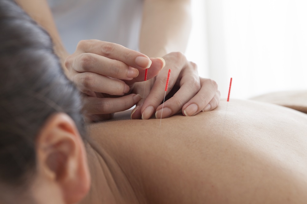 Back-Pain-Acupuncture-in-Oakville-Ontario