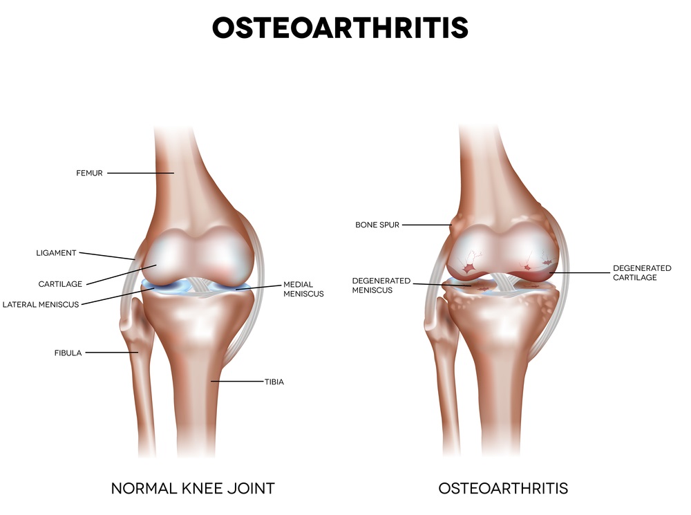 Osteoarthritis-Symptom-near-Oakville-Ontario