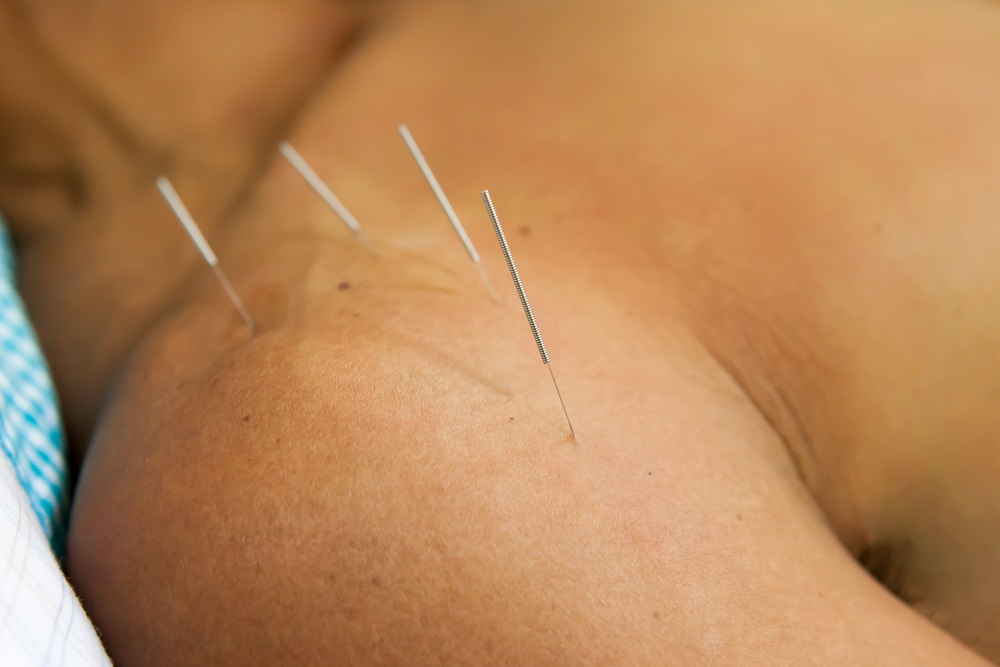 Shoulder-and-Joint-Acupuncture-Oakville-Ontario