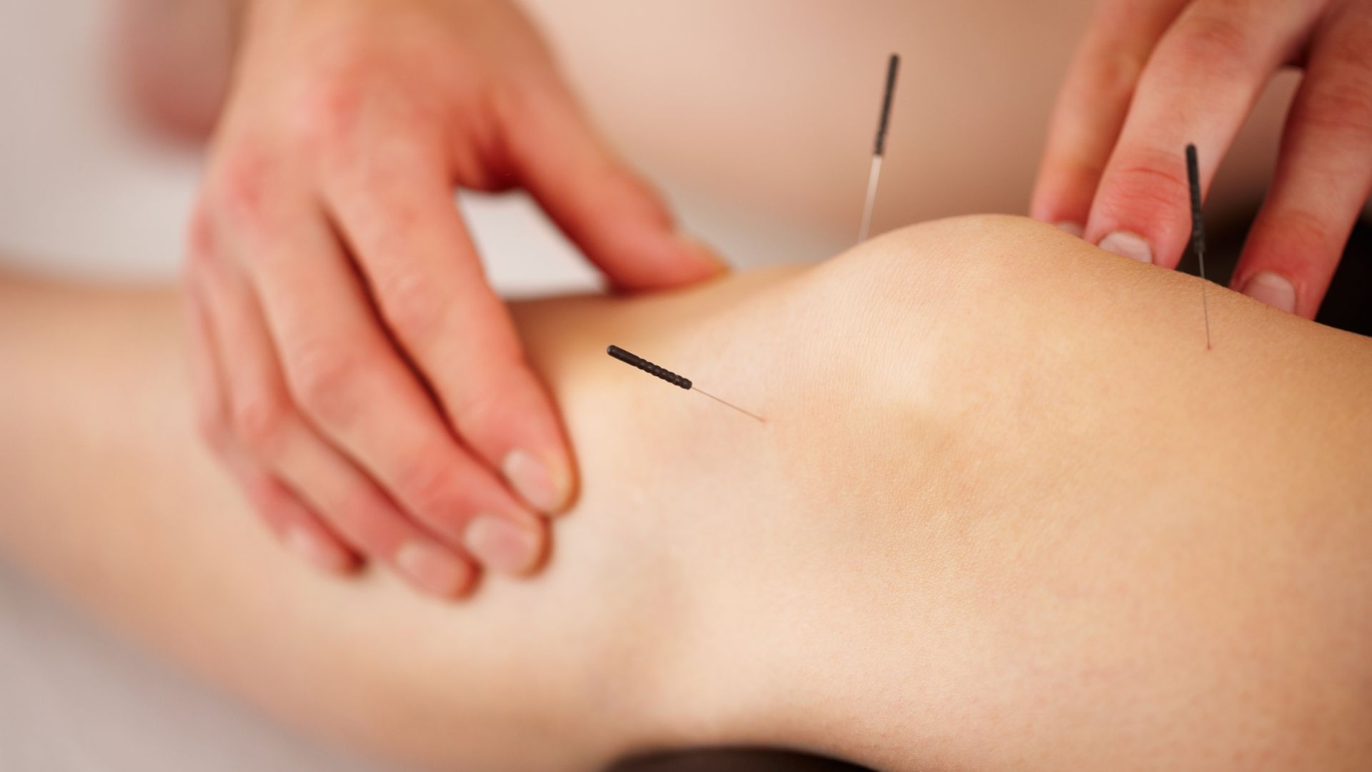 Relieving Labor Pains with Acupuncture